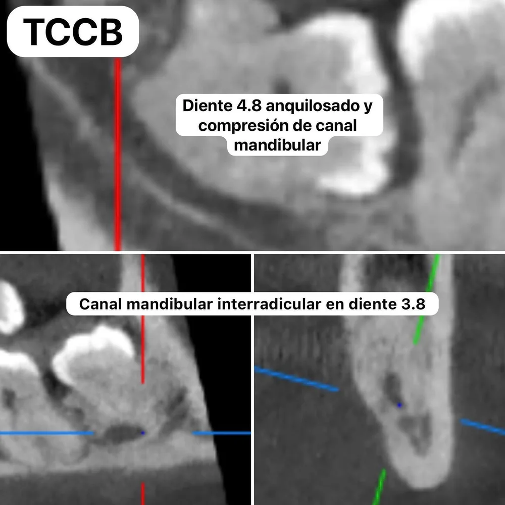 Tomografía de una muela del juicio anquilosada que comprime el canal mandibular.