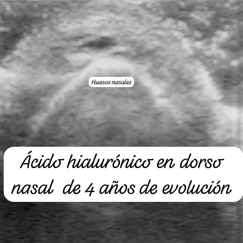 Ecografía facial: ácido hialurónico en el dorso nasal, 4 años después.