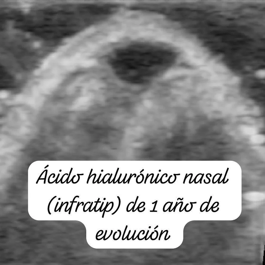 Ecografía facial: ácido hialurónico en la punta nasal, 1 año después.