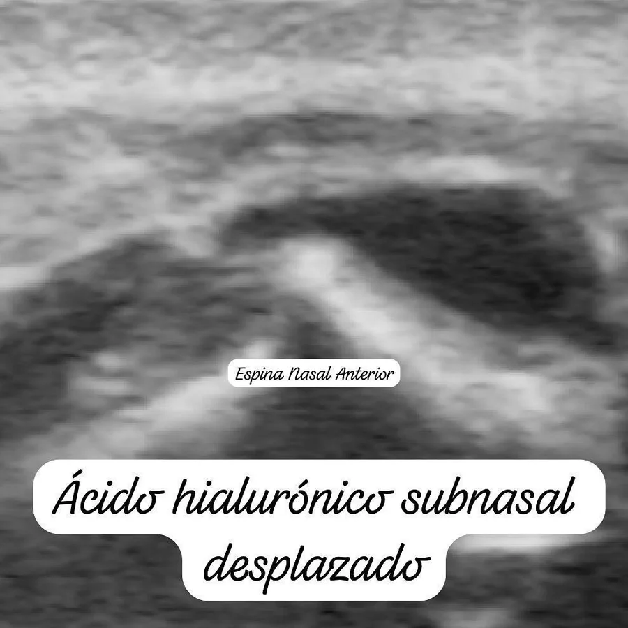 Ecografía facial: ácido hialurónico subnasal desplazado.