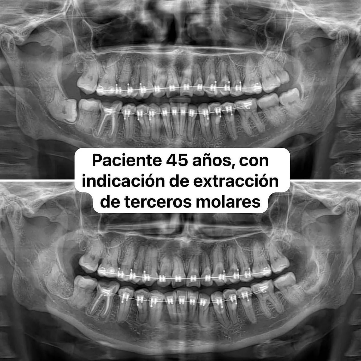 Radiografía panorámica de una paciente de 45 años con indicación de extracción de muelas del juicio.